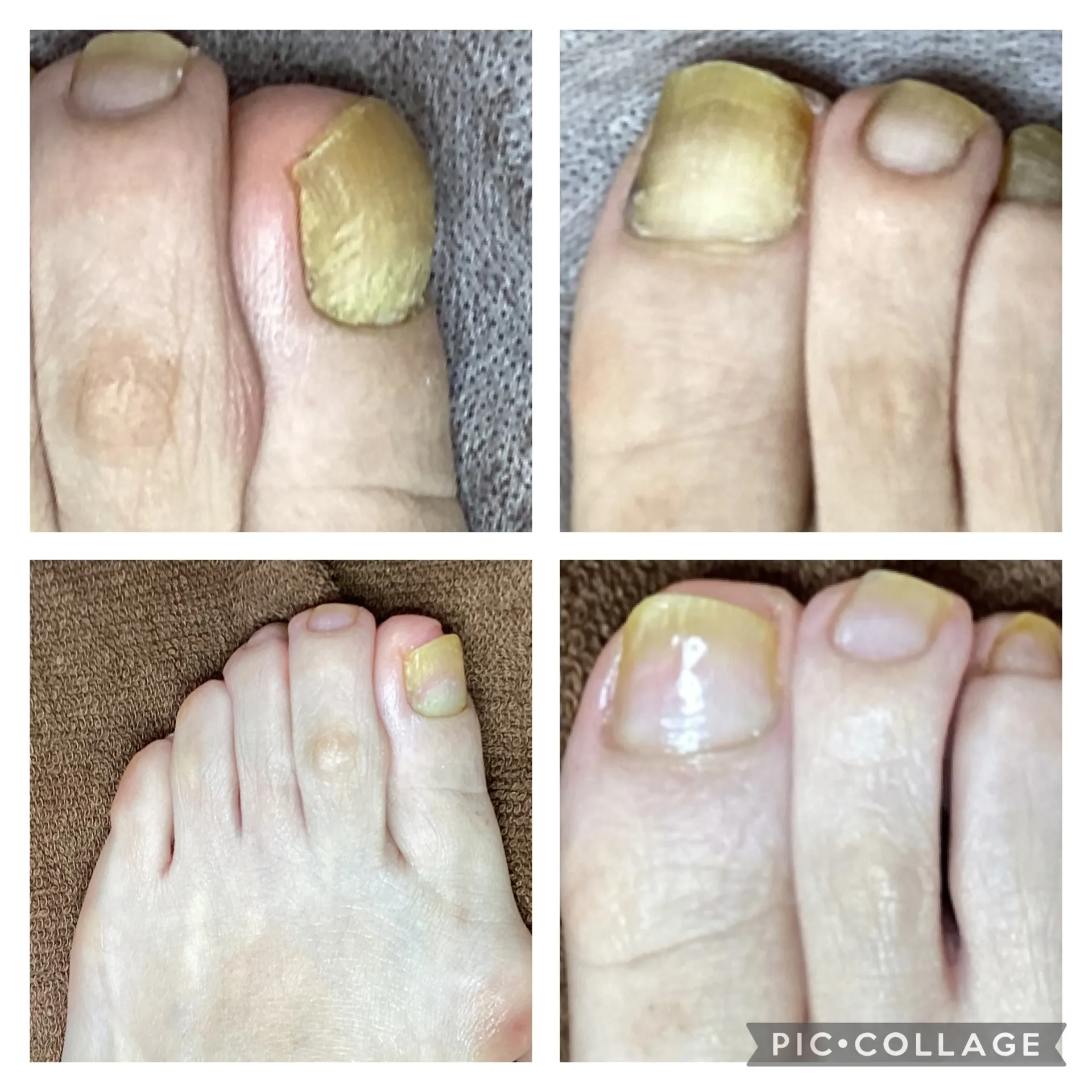 爪の肥厚でうまく爪切りできない