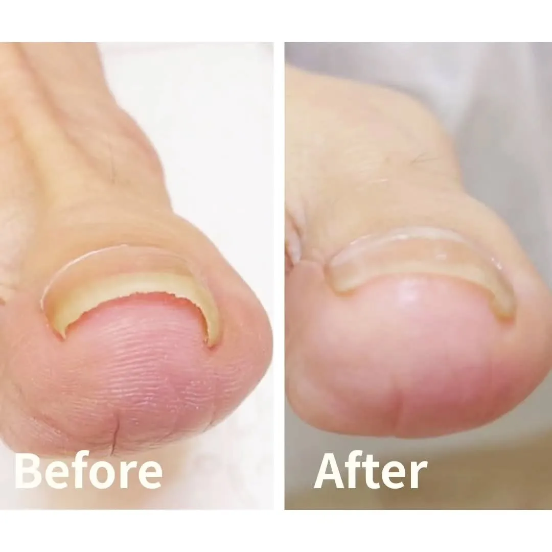 つめの角が食い込む方