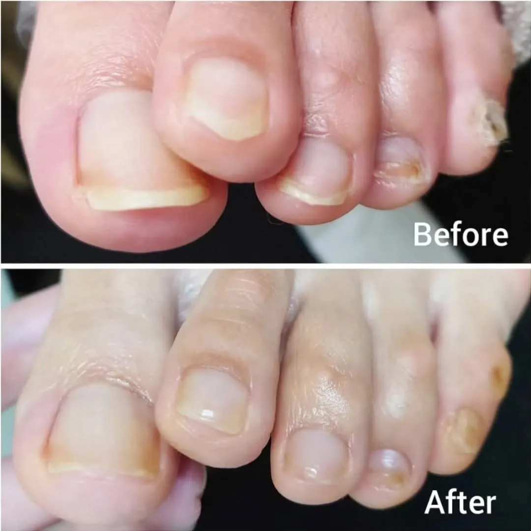 つめの角が食い込む方