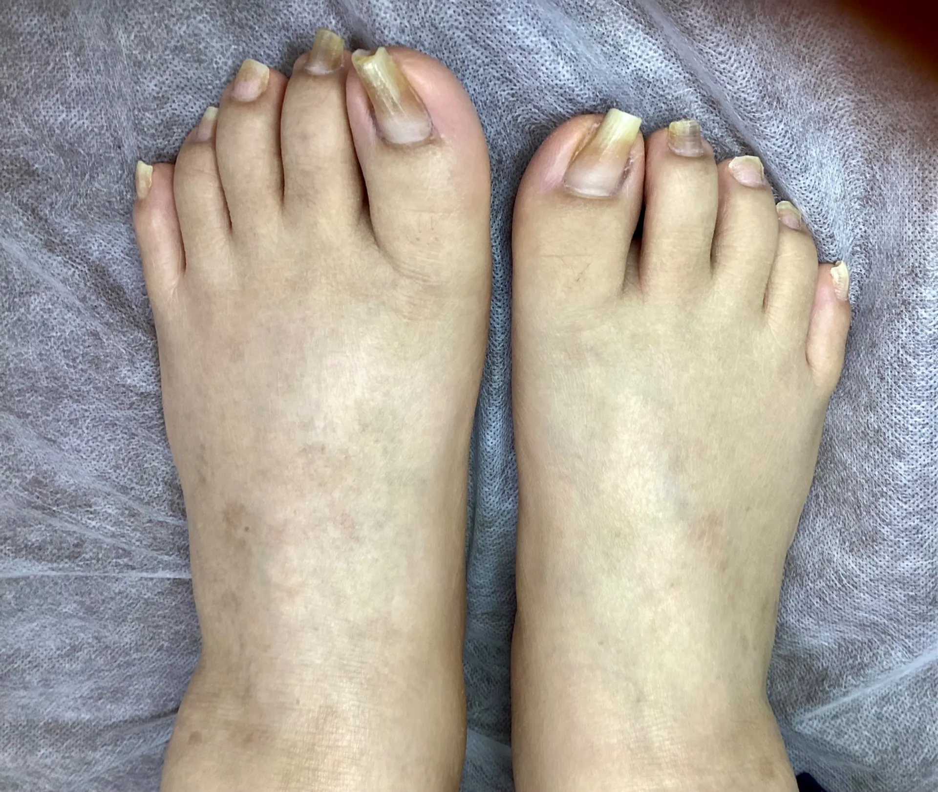 巻きがだいぶ改善しました