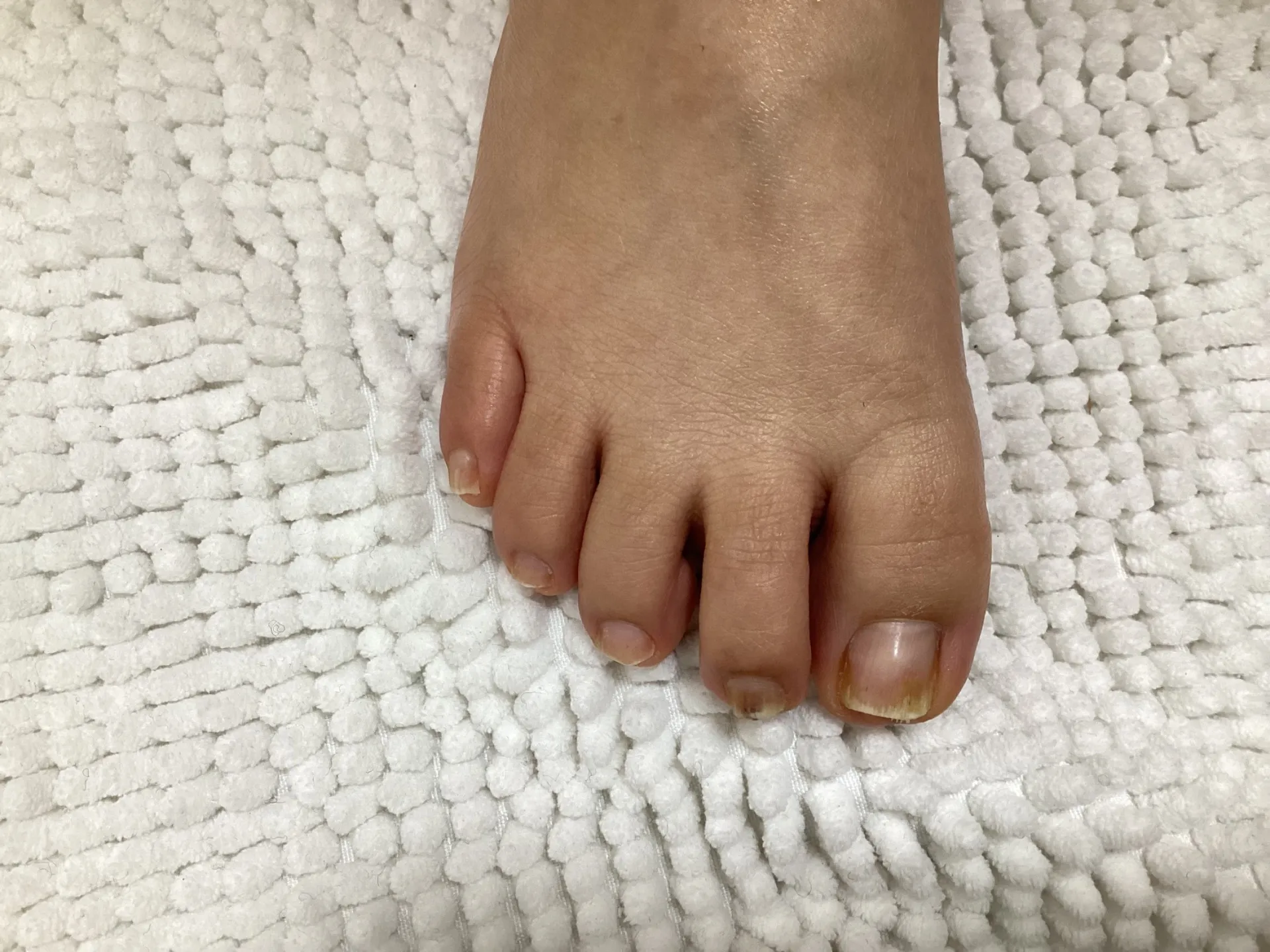 巻きがだいぶ改善しました