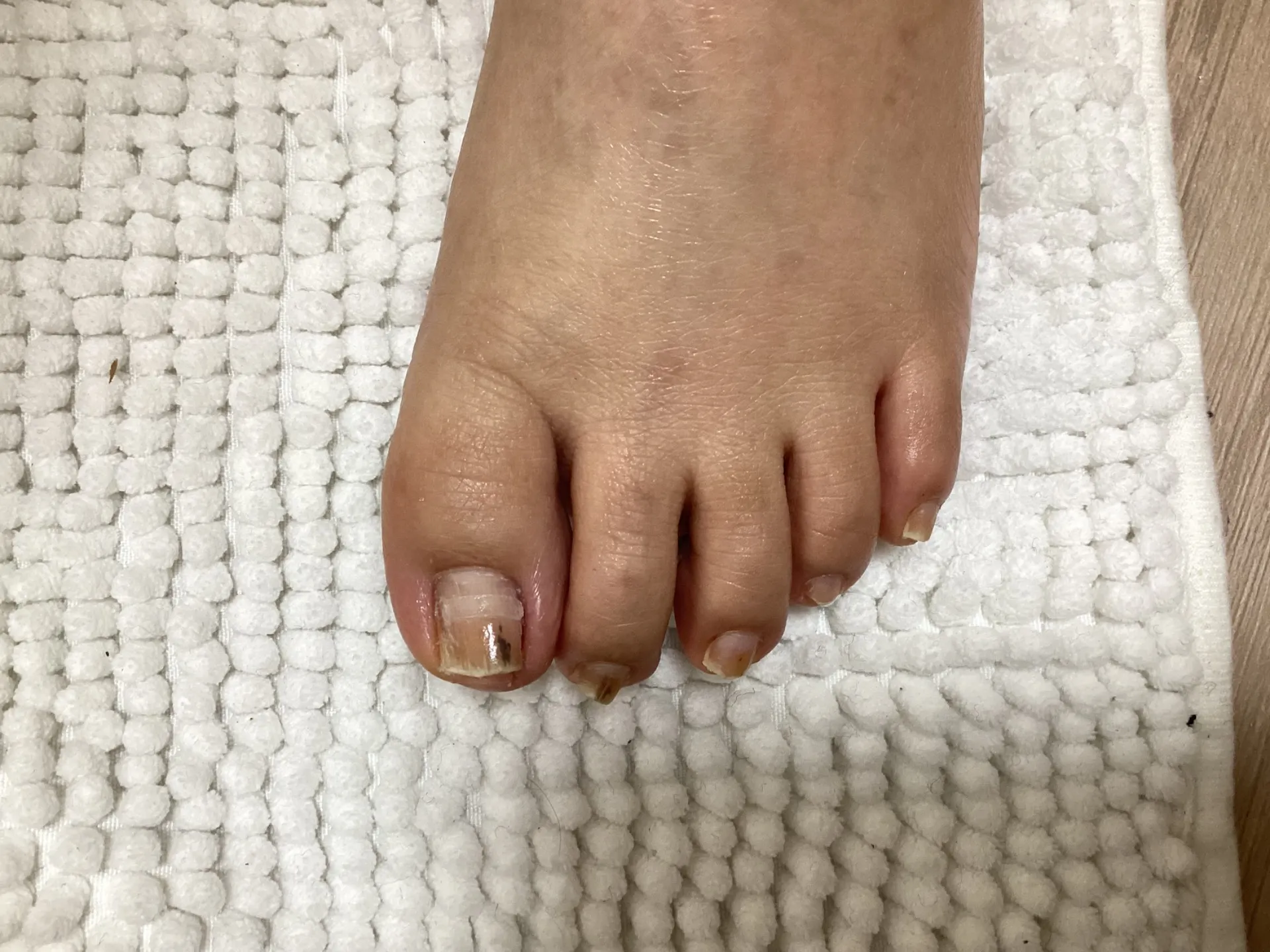 巻きがだいぶ改善しました