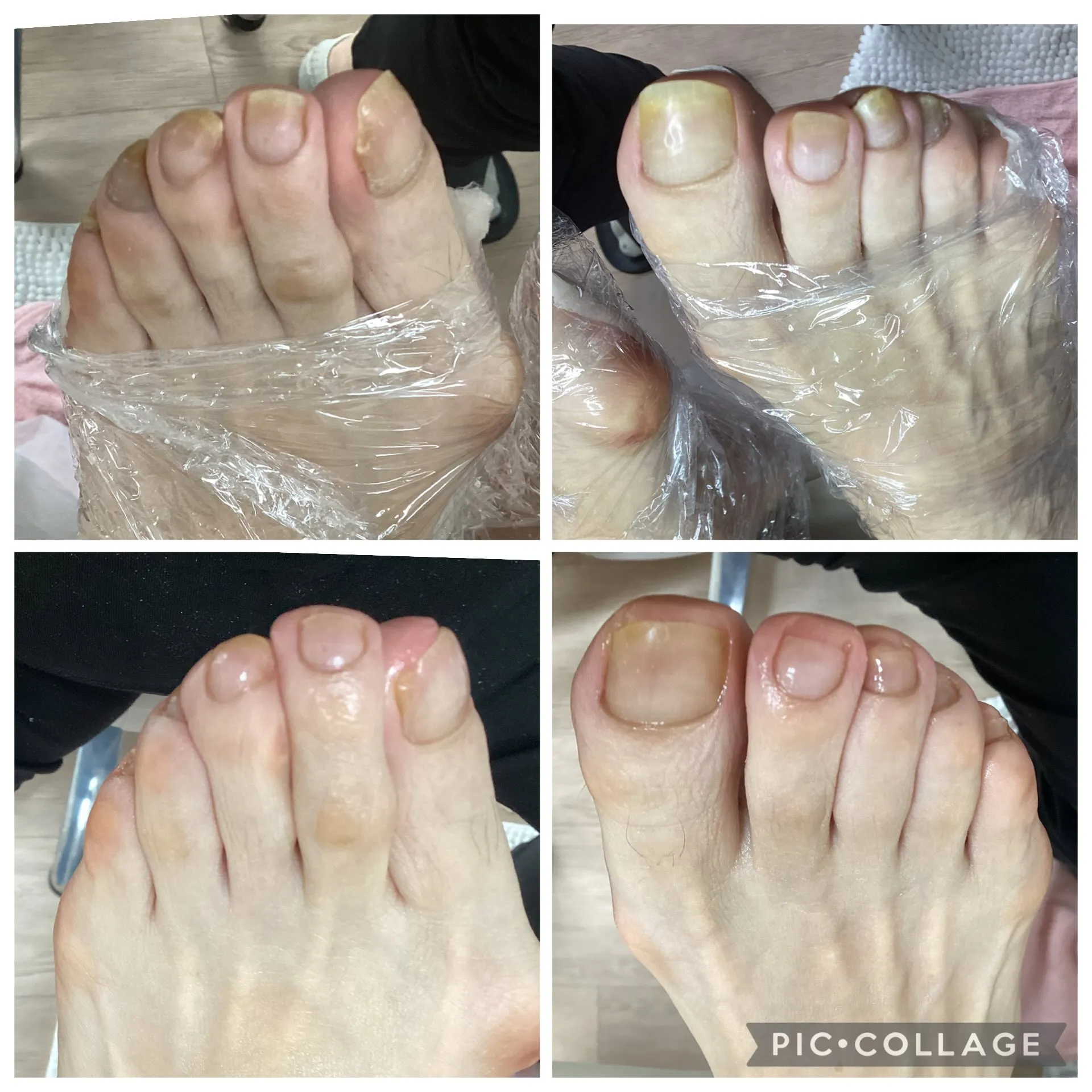 切りにくい爪、