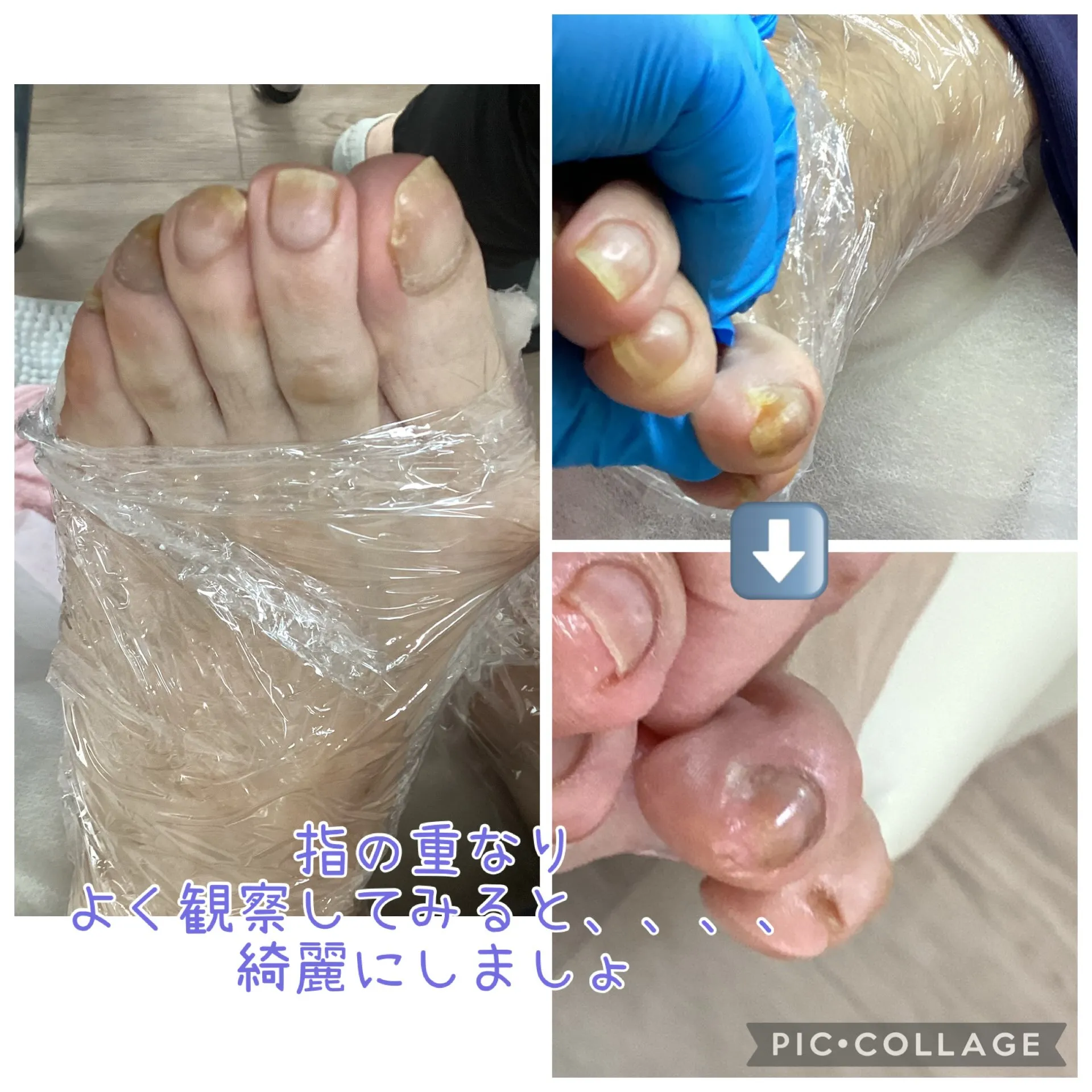 切りにくい爪、